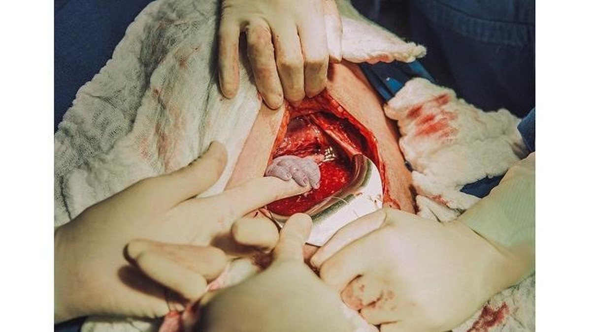 Bebê segura mão de obstetra ainda no útero (Foto: Reprodução/Instagram/
