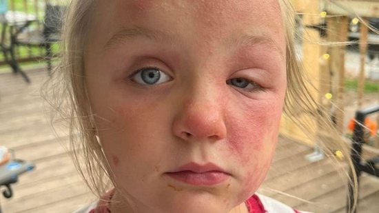 A criança ficou com diversas erupções na pele, por conta da reação alérgica - Reprodução/The Mirror
