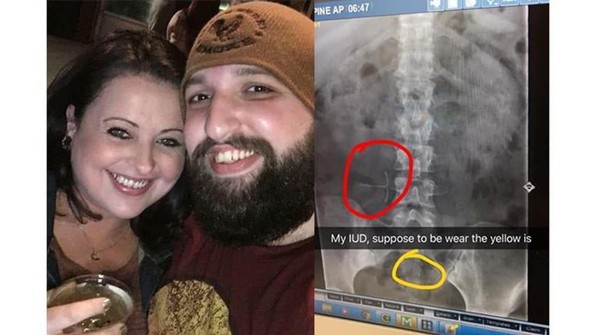 Melinda postou raio-X onde o DIU foi achado 11 anos depois (Foto reprodução/Facebook)