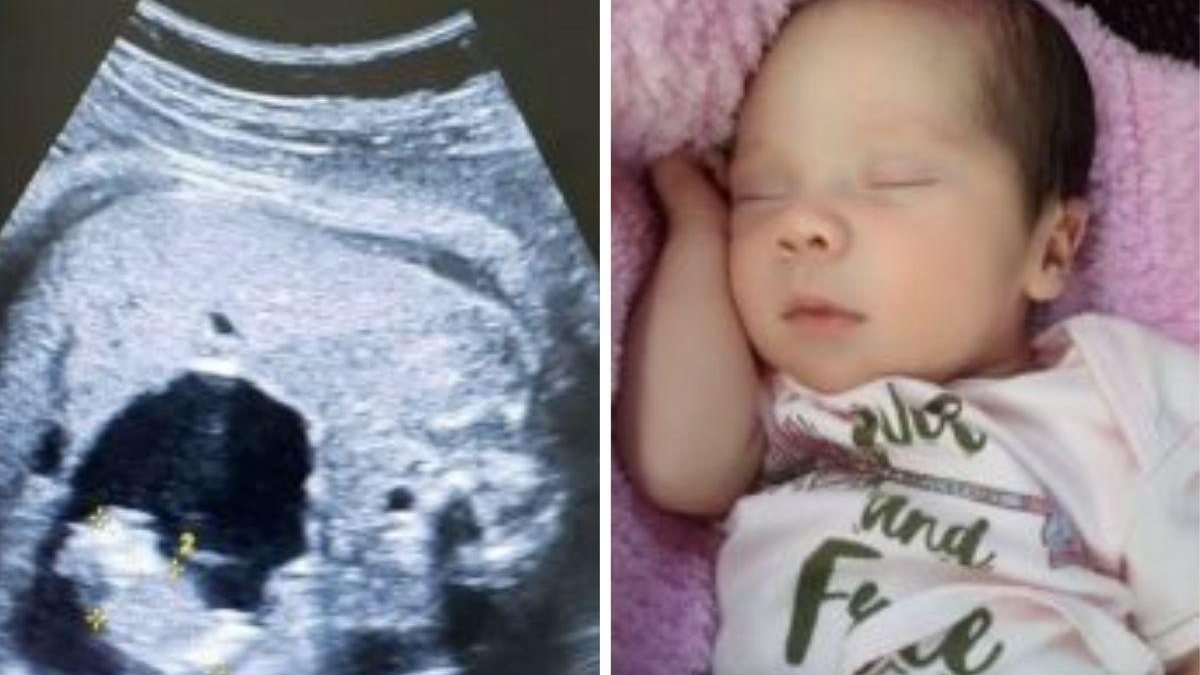 A bebê carregava uma gêmea dentro do abdômen - Getty Images