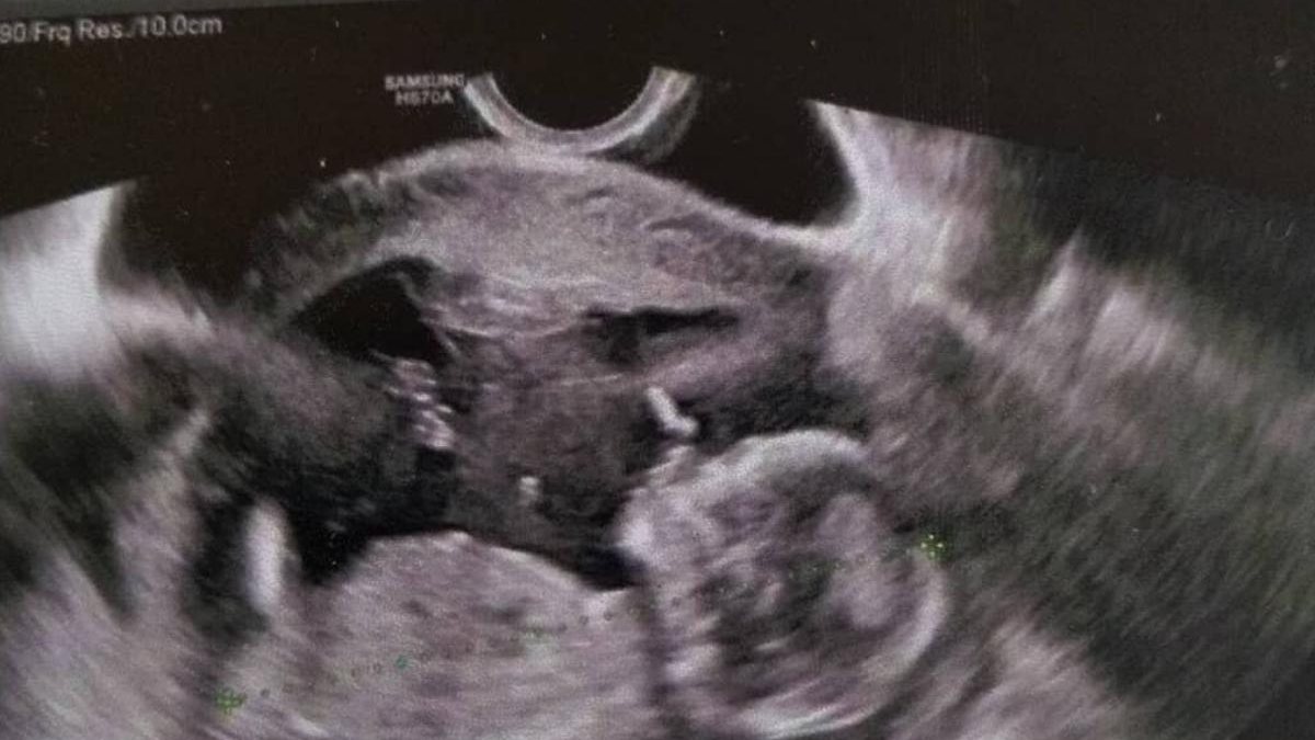 “Tenho um bebê de 11 meses. Fiz laqueadura’”, desabafa Edmara - reprodução / Instagram