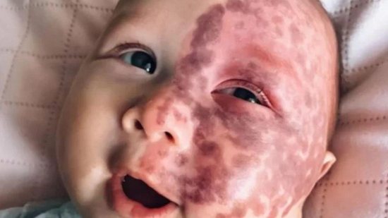 Bebê de 5 meses passa por tratamento com laser - Reprodução/Instagram