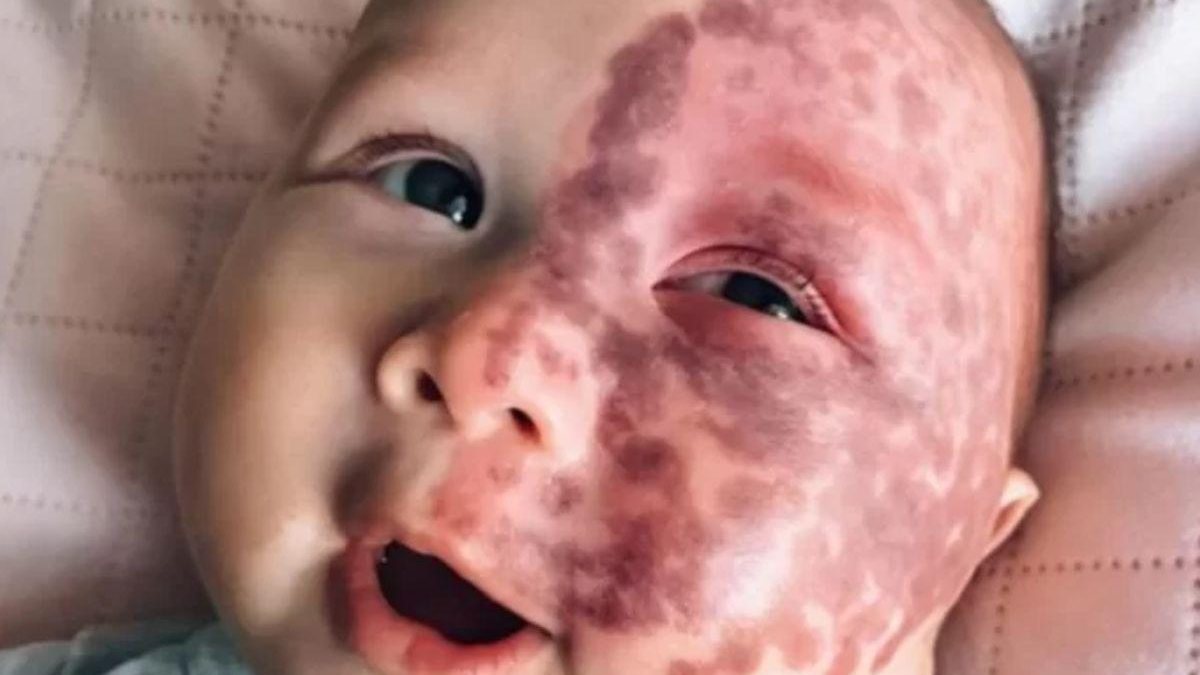 Bebê de 5 meses passa por tratamento com laser - Reprodução/Instagram