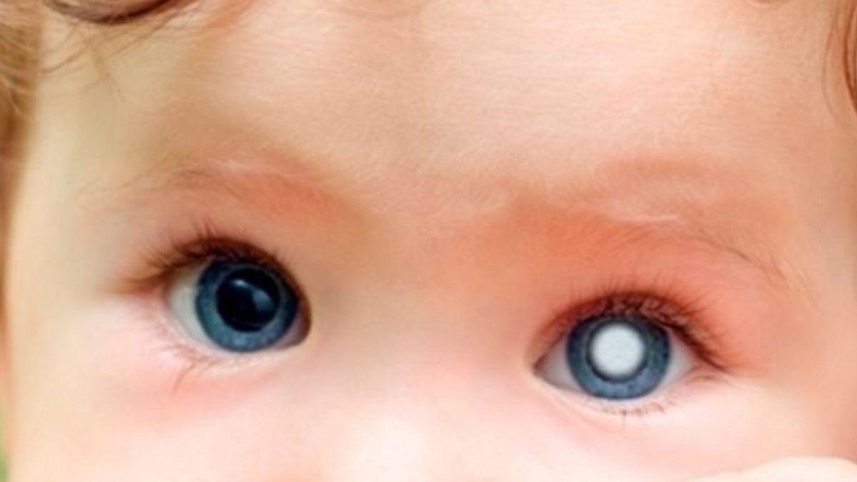 Crianças que apresentam a condição podem ter sensibilidade à luz e visão dupla - Reprodução/iStock