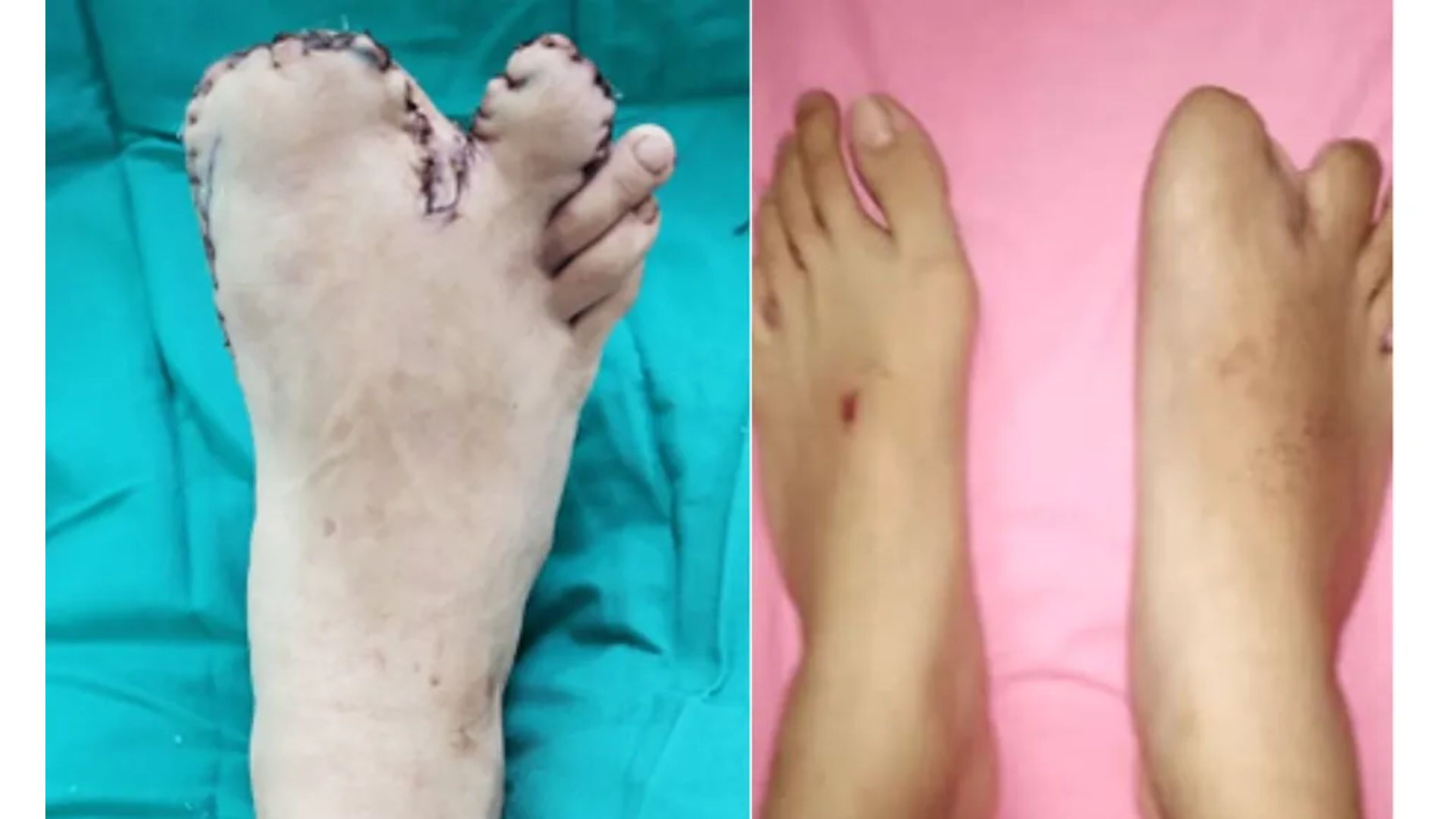Menina de 12 anos tem gigantismo nos dedos dos pés