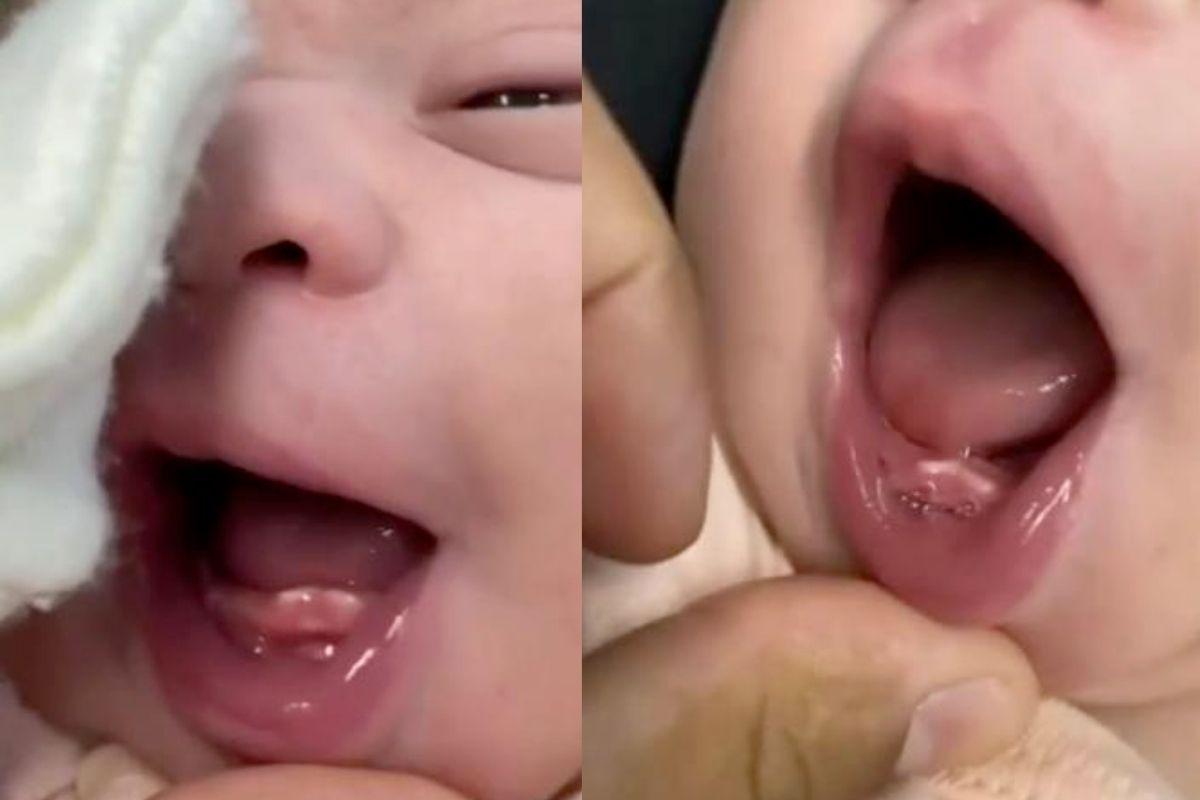 Emanuelle já nasceu com 2 dentes 