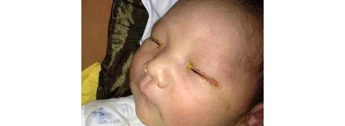 Essa foto está circulando pela internet como o bebê que perdeu a visão por causa do flash de uma câmera. Apesar de o fato não ser comprovado, é um alerta importante para a sensibilidade dos olhos das crianças.