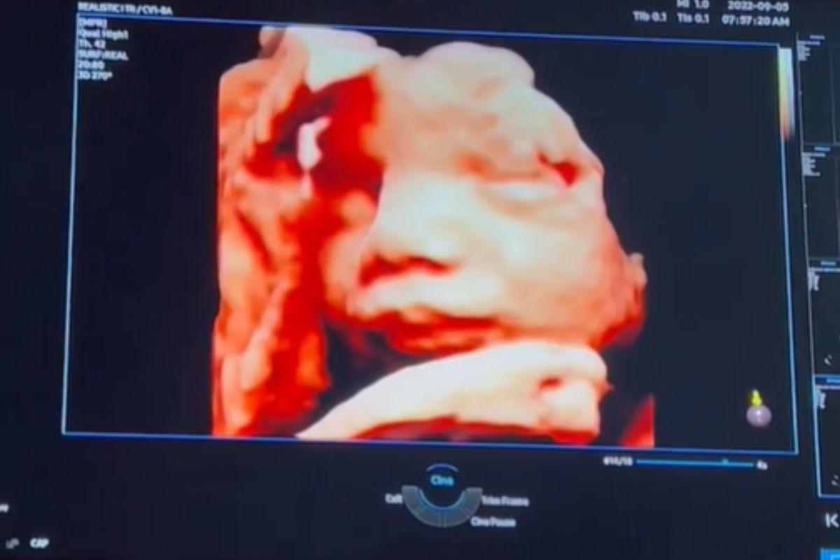 ultrassom mostra rosto de Lion pela primeira vez