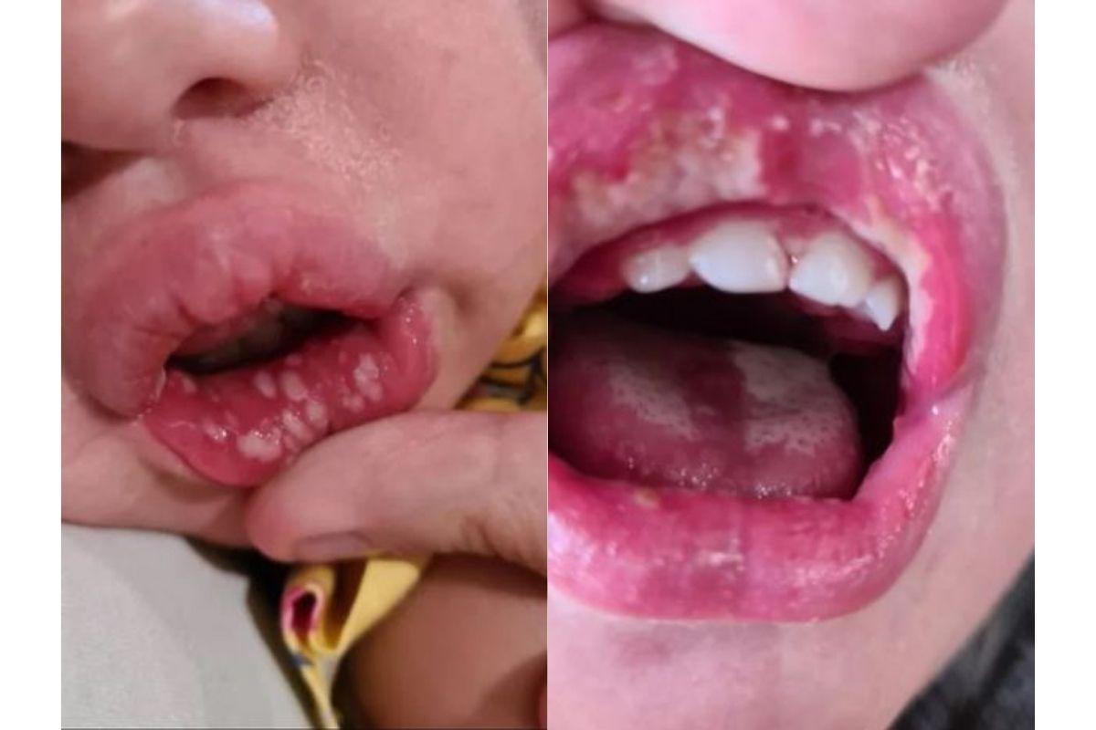 A menina ficou com diversas feridas na boca devido a herpes