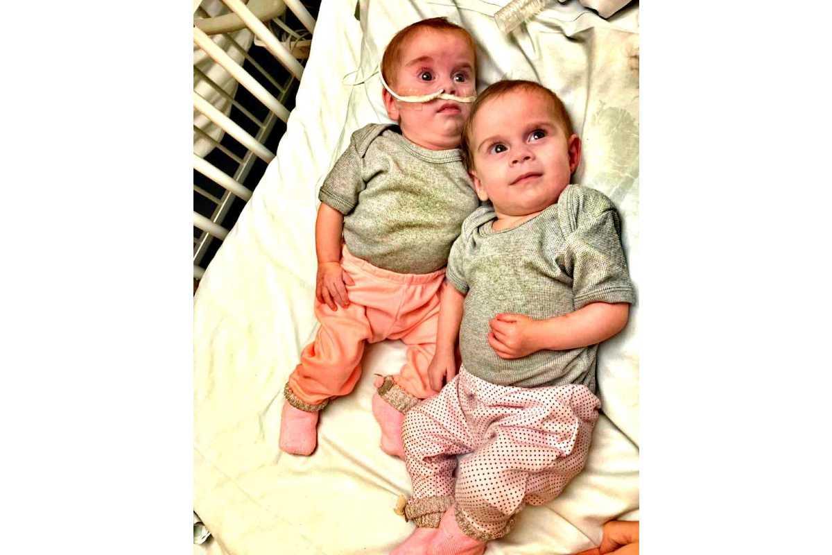 Gêmeas siamesas já separadas após cirurgia com impressão 3D 