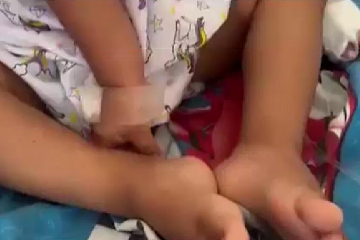 Menino de dois anos engole 8 agulhas