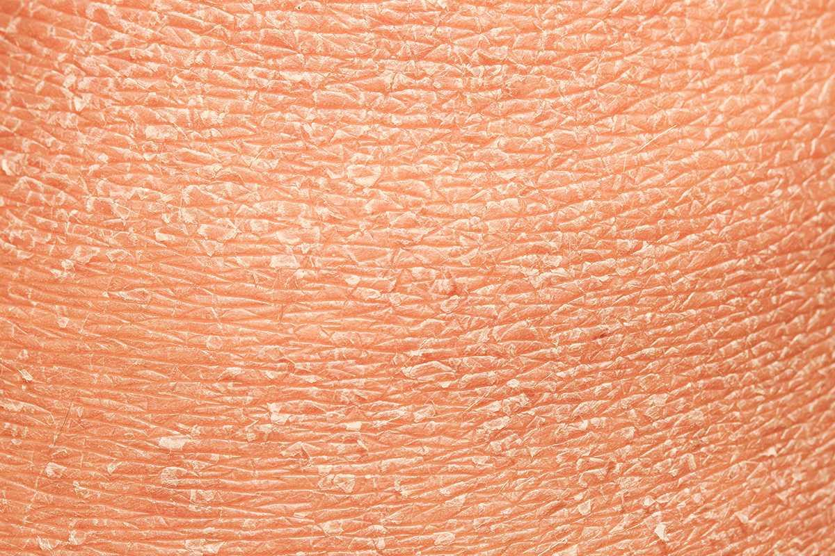 A pele seca é uma das causas da dermatite atópica