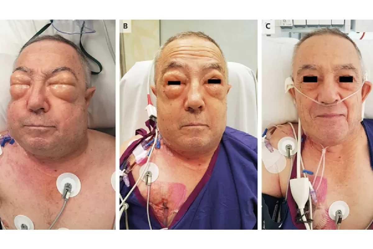 Um australiano de 75 anos teve corpo e rosto alterados após passar por cirurgia 