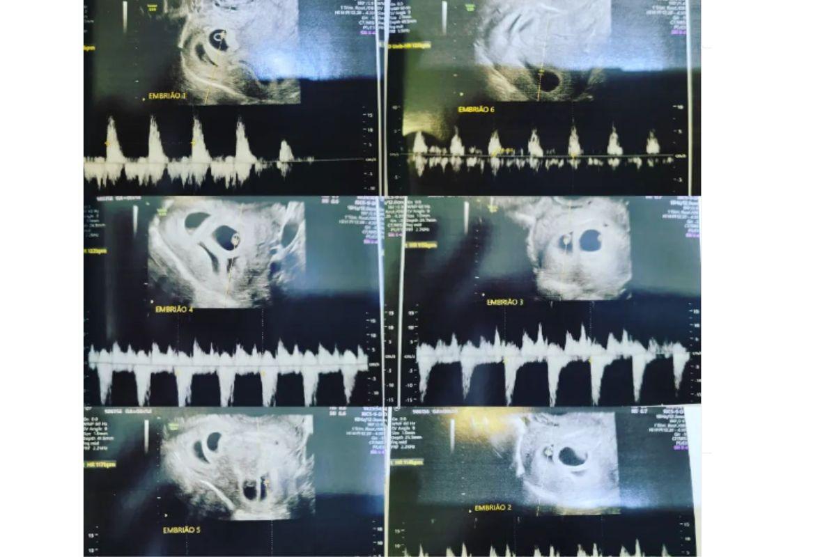 Mãe de sextuplos mostra ultrassom dos bebês