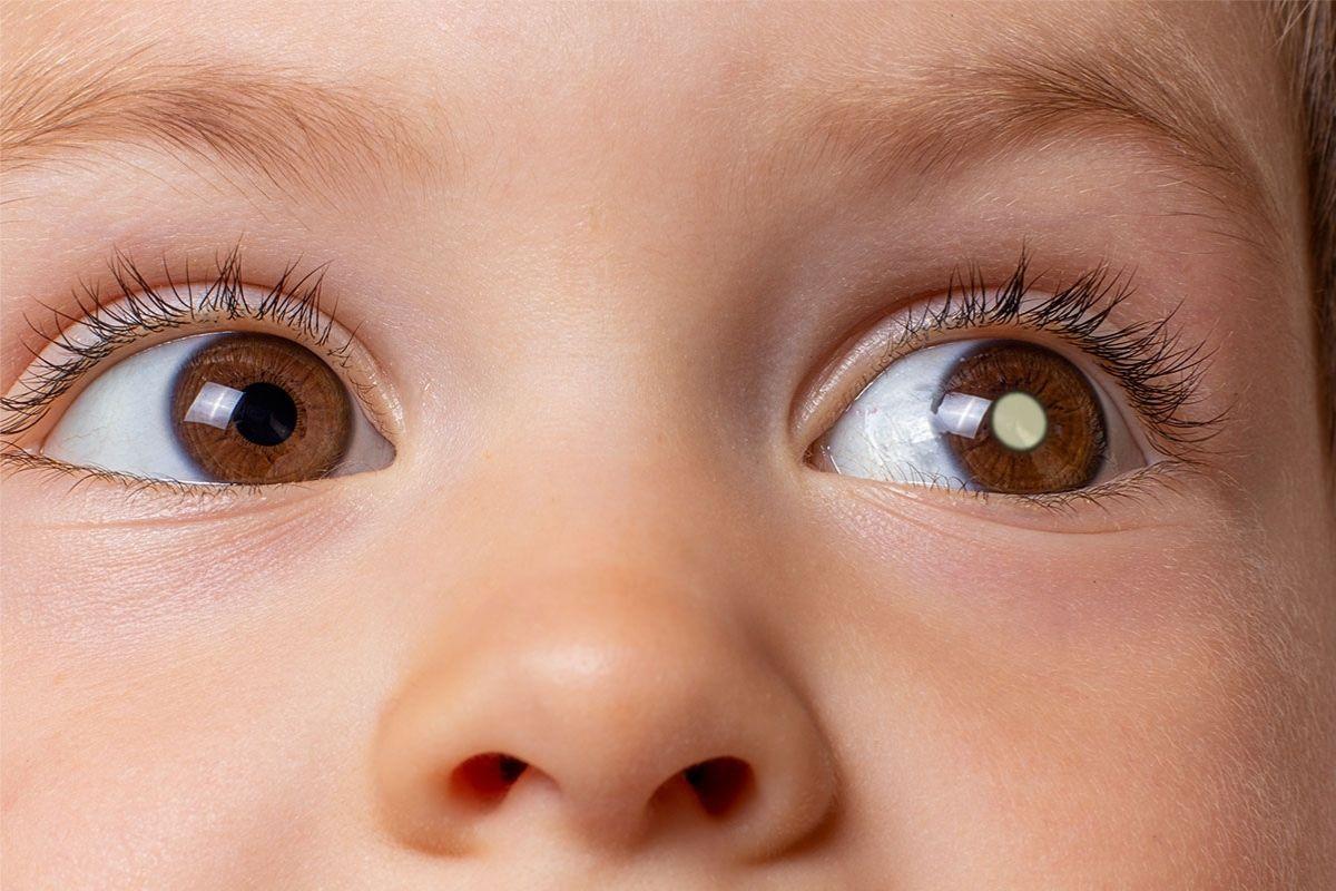 O retinoblastoma é um câncer raro nos olhos