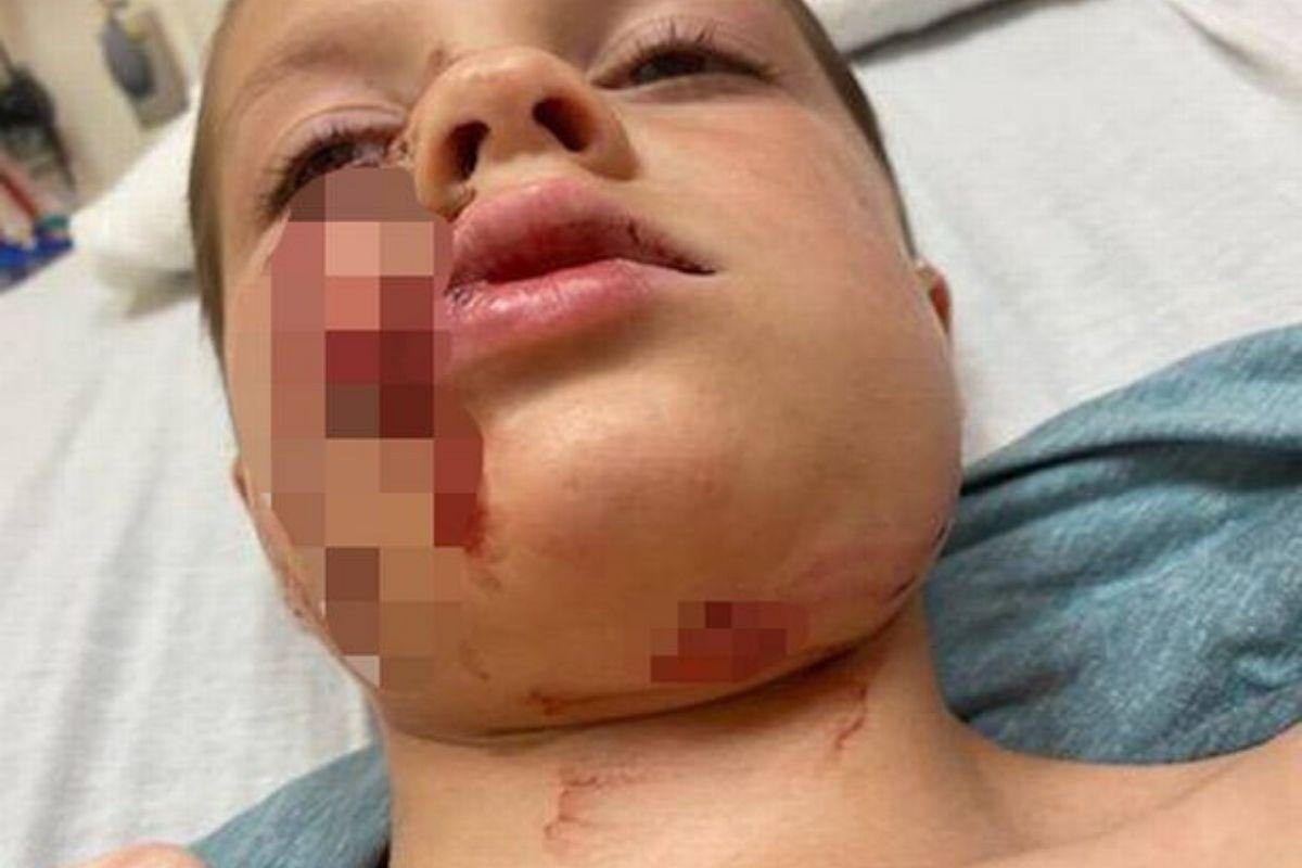 O rosto do menino ficou desfigurado após o ataque do cachorro 