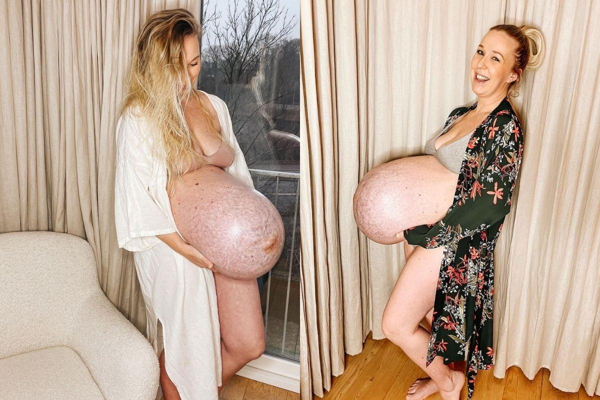 Mãe de 2 e grávida de trigêmeos mostra foto impressionante da barriga um dia antes do parto