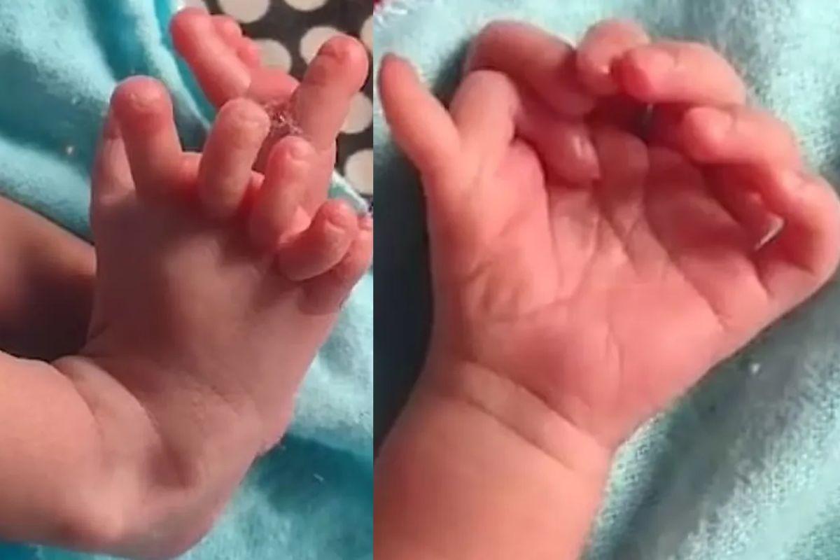 A bebê nasceu com 26 dedos