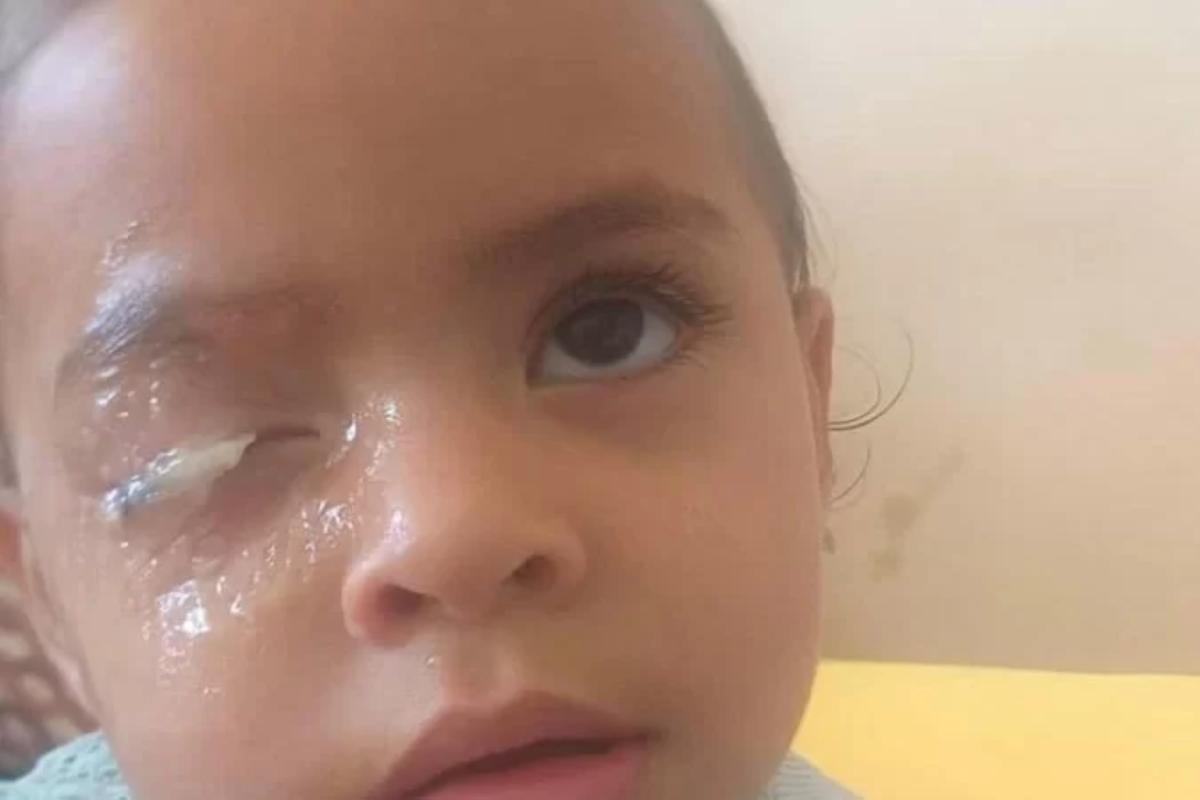 Criança de 2 anos gruda o olho com cola instantânea