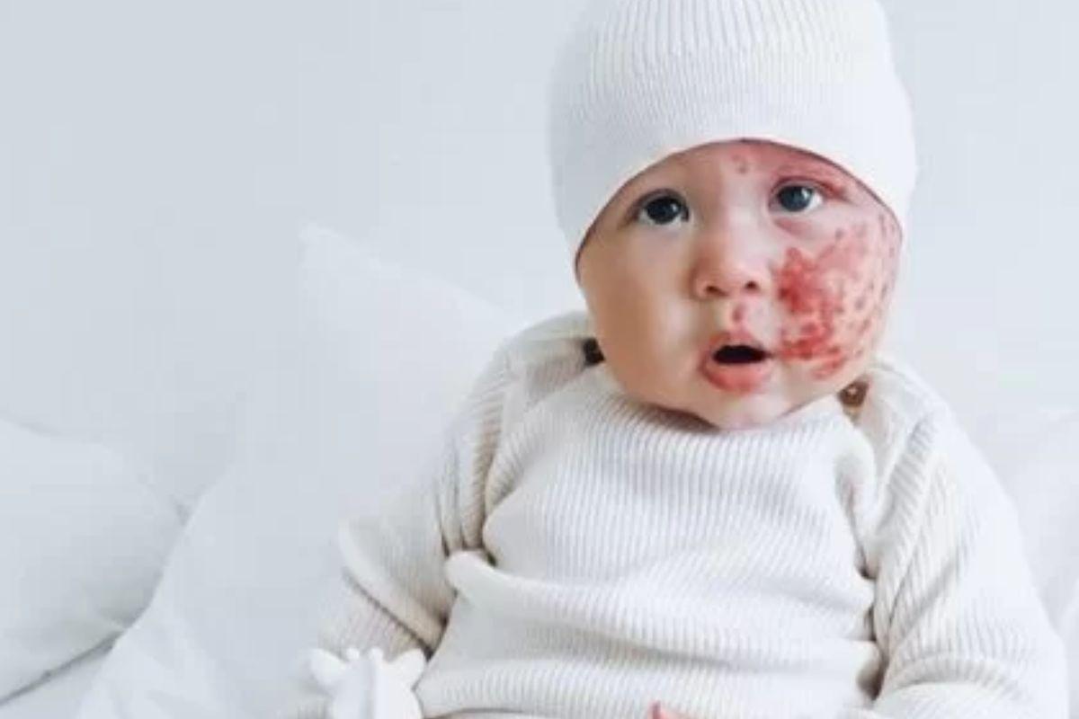 Bebê australiano nasce com marcas no rosto