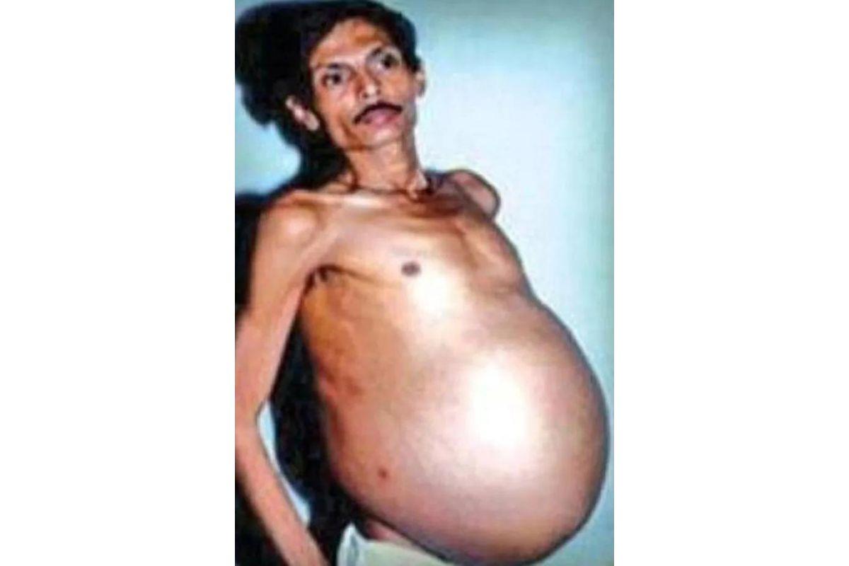 homem gravido sanju bhagat