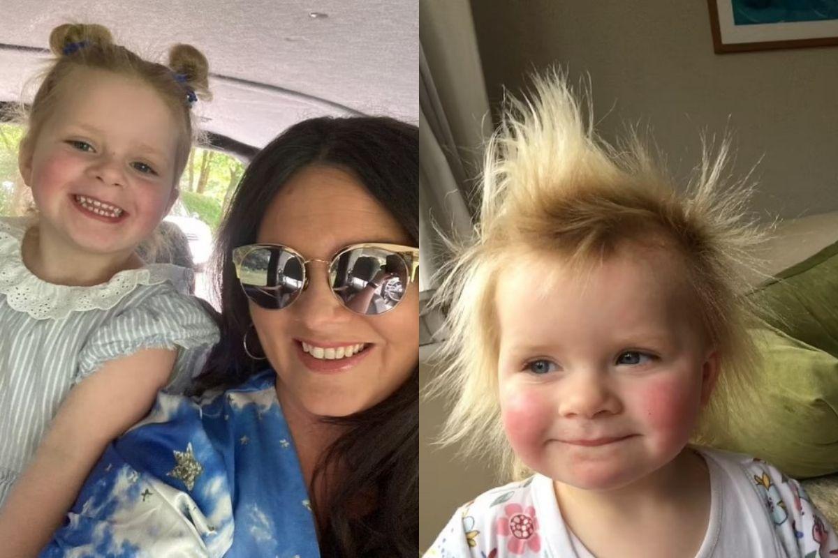 A menina nasceu com a 'síndrome do cabelo impenteável' 