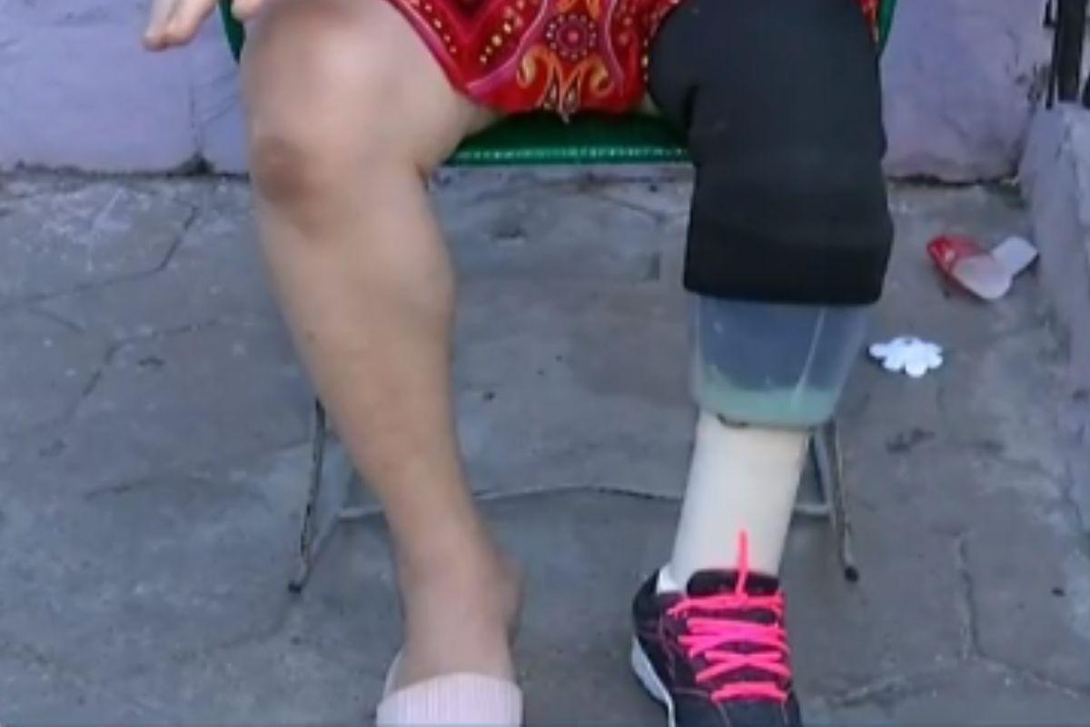 Mulher usa copo de liquidificador como prótese após amputar a perna