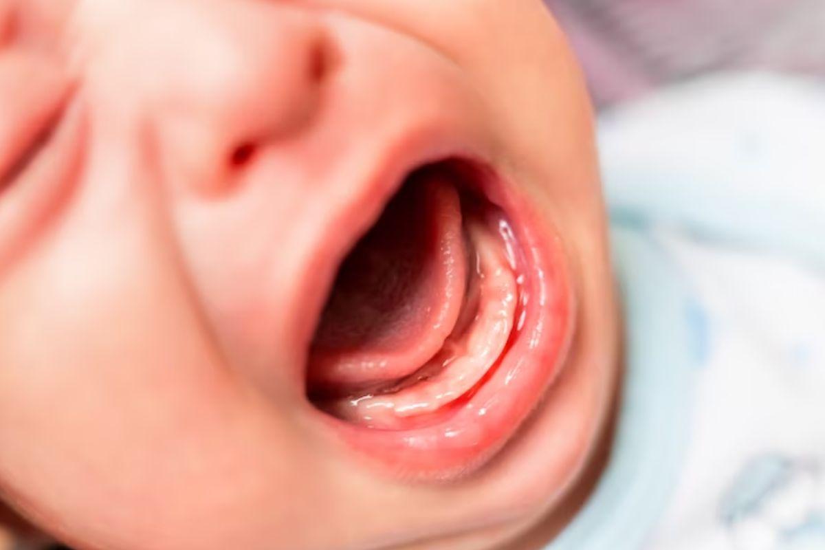 Primeiros dentes, dentes bebê, primeiros dentes de bebê, bebê com dentes nascendo, nascimento de dentes de bebê, gengiva bebê