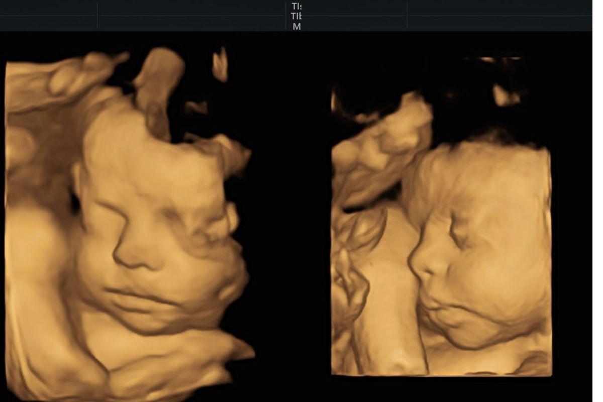 Tays está grávida de 30 semanas e mostrou o rosto da filha em uma ultrassonografia