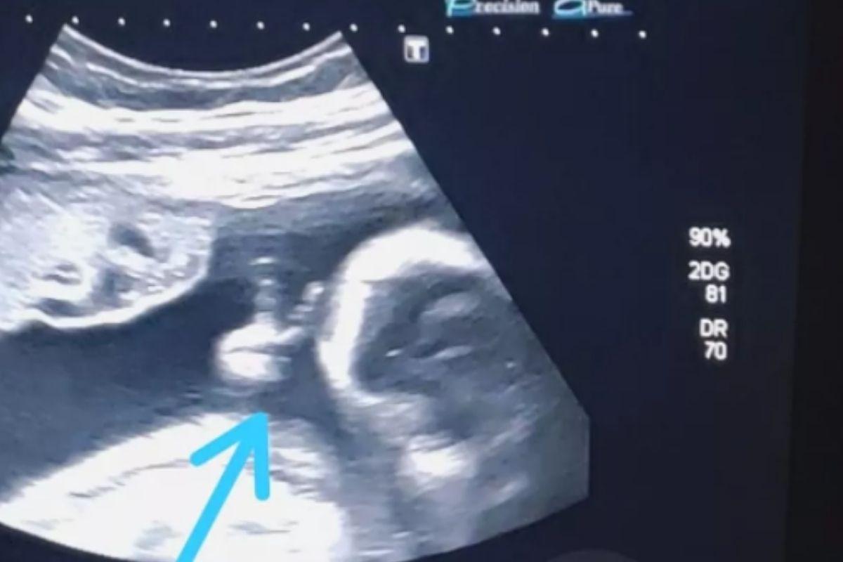 Bebê faz 'V' com a mãe em ultrassom