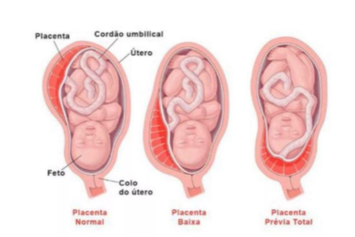 Placenta na gravidez, publicado por Rafa Brites